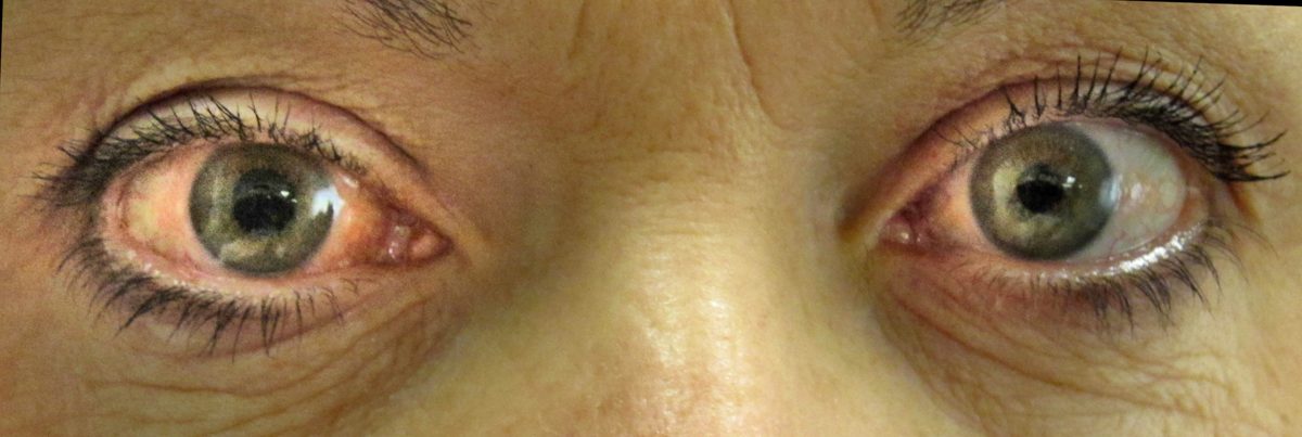 Medição da pressão intraocular para glaucoma