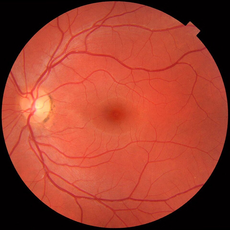 Avaliação de retina com equipamento de imagem